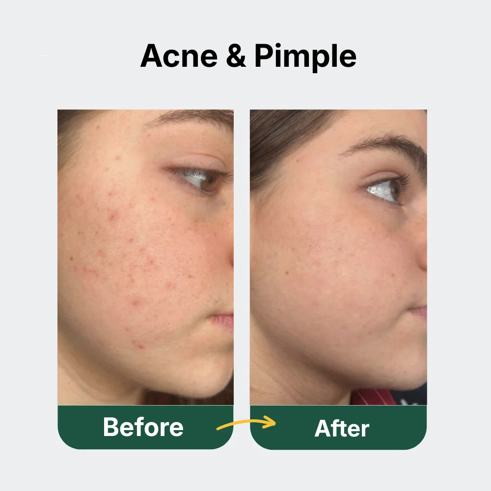 Silicone Photon Rejuvenation Mask